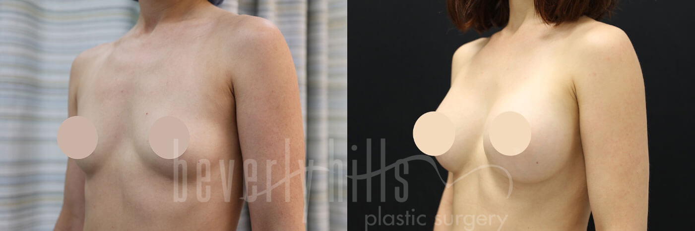 Breast Augmentation 73 Before & After