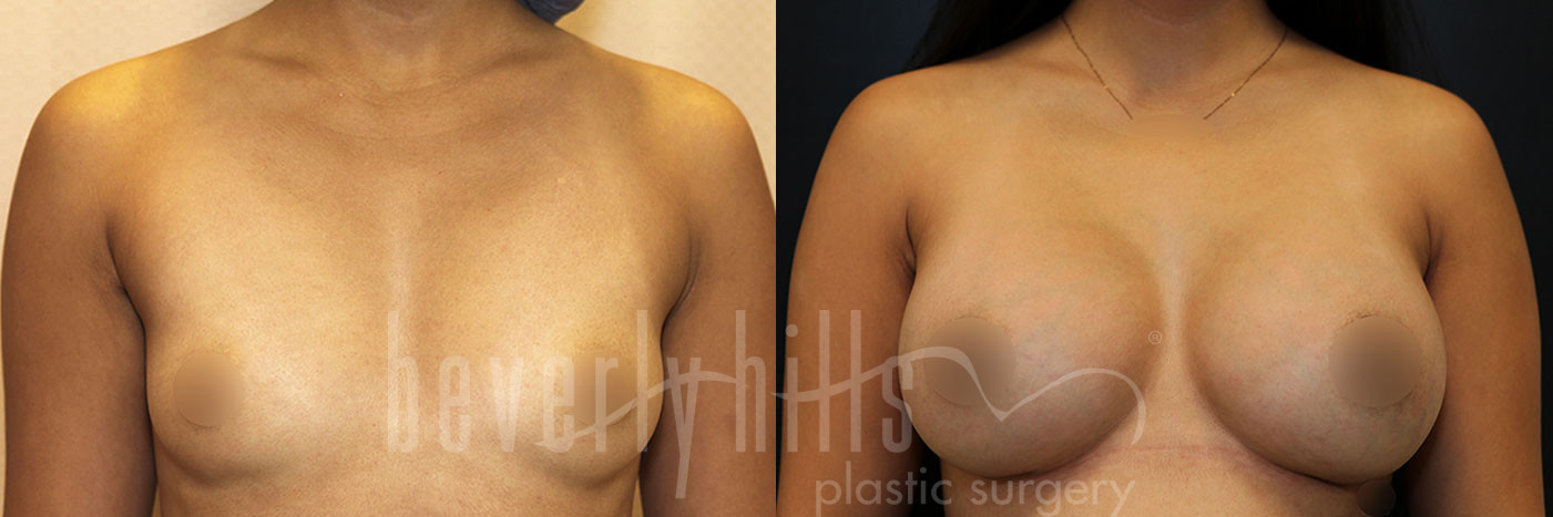 Breast Augmentation 105 Before & After