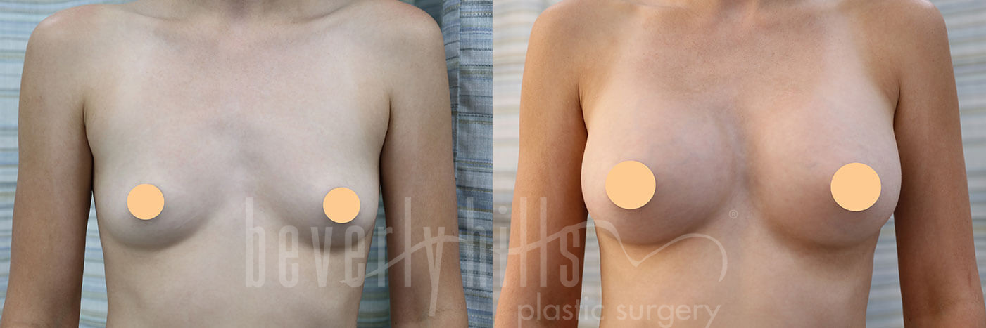 Breast Augmentation 102 Before & After