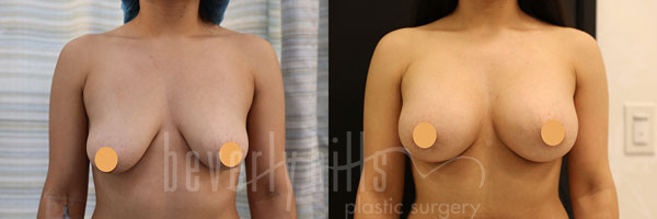 Breast Augmentation 80 Before & After