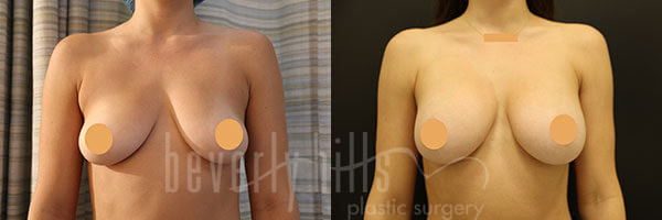 Breast Augmentation Patient 88 Before & After