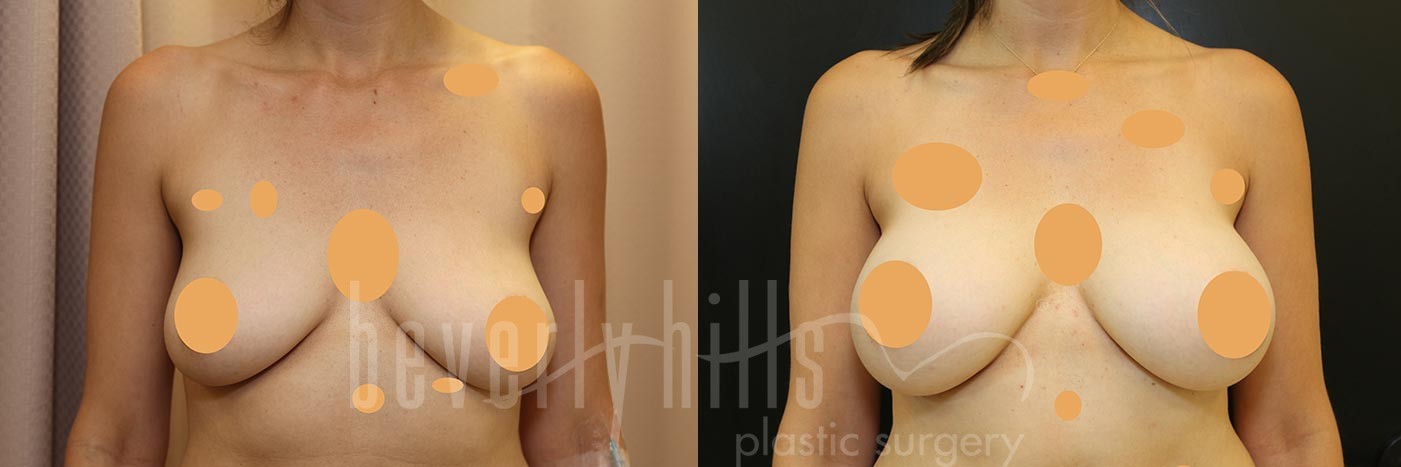 Breast Augmentation Patient 91 Before & After