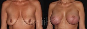 Breast Lift 01 Before & After - Thumbnail