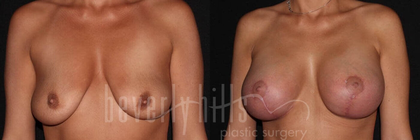 before and after breast lift-1
