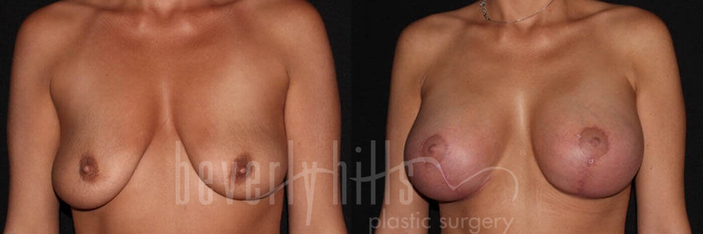 Breast Lift 01 Before & After