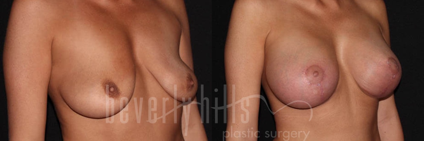 Breast Lift 01 Before & After