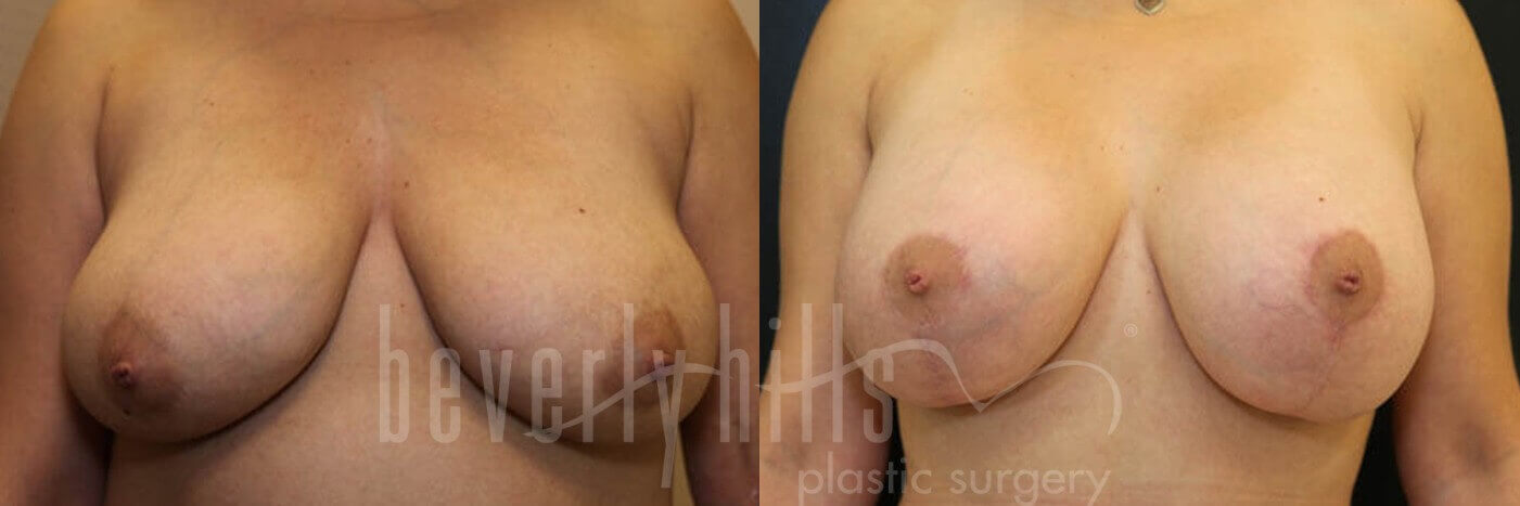 Breast Lift 02 Before & After