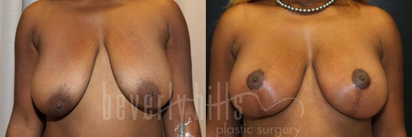 Breast Lift 03 Before & After