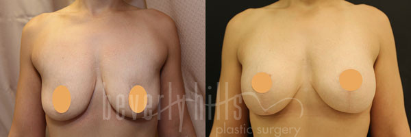 Breast Lift 04 Before & After