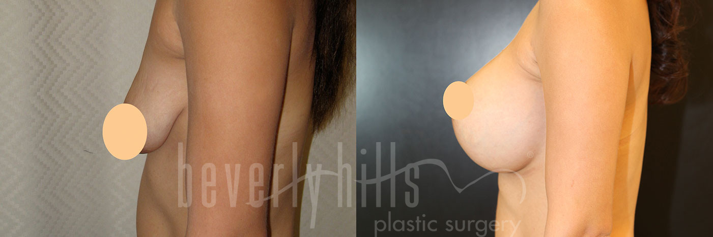 BREAST LIFT 10 Before & After