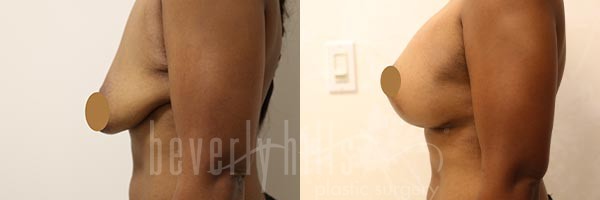 Breast Lift Patient 06 Before & After