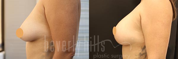 Breast Lift Patient 07 Before & After