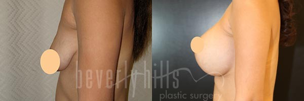 Breast Lift Patient 08 Before & After