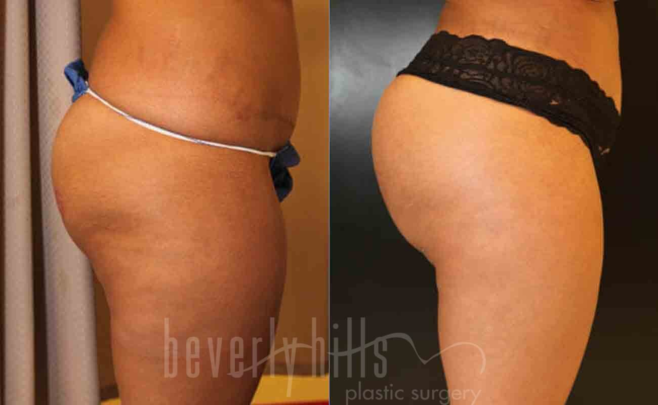 Butt Augmentation Patient 01 Before & After