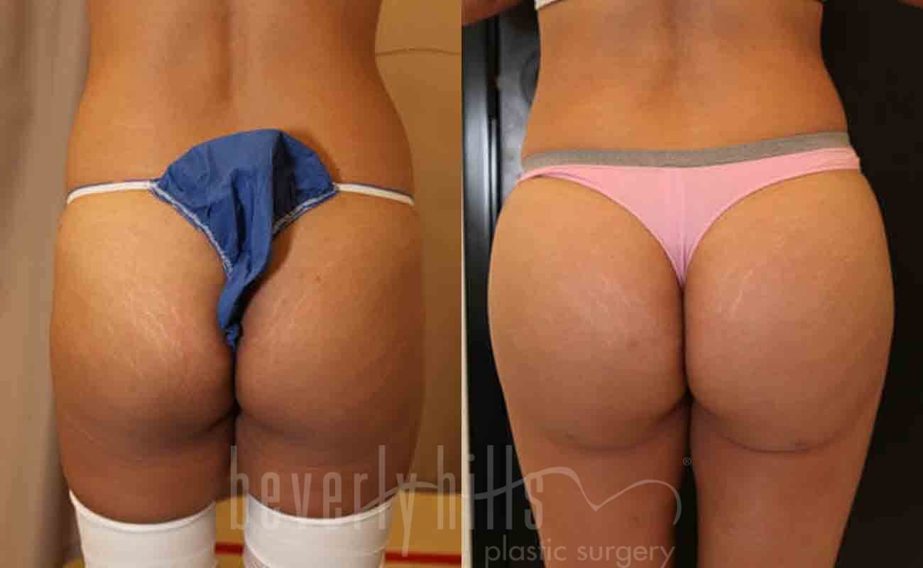 Butt Augmentation Patient 02 Before & After