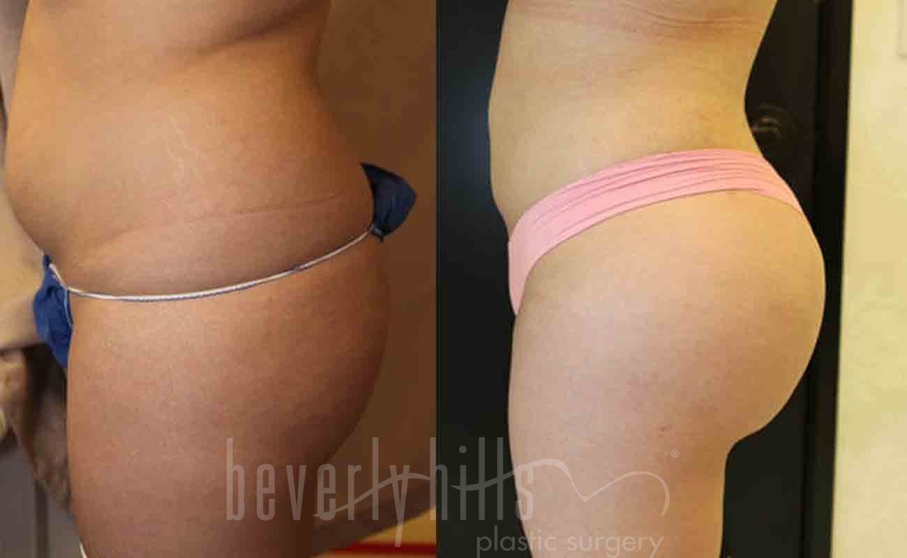 Butt Augmentation Patient 03 Before & After