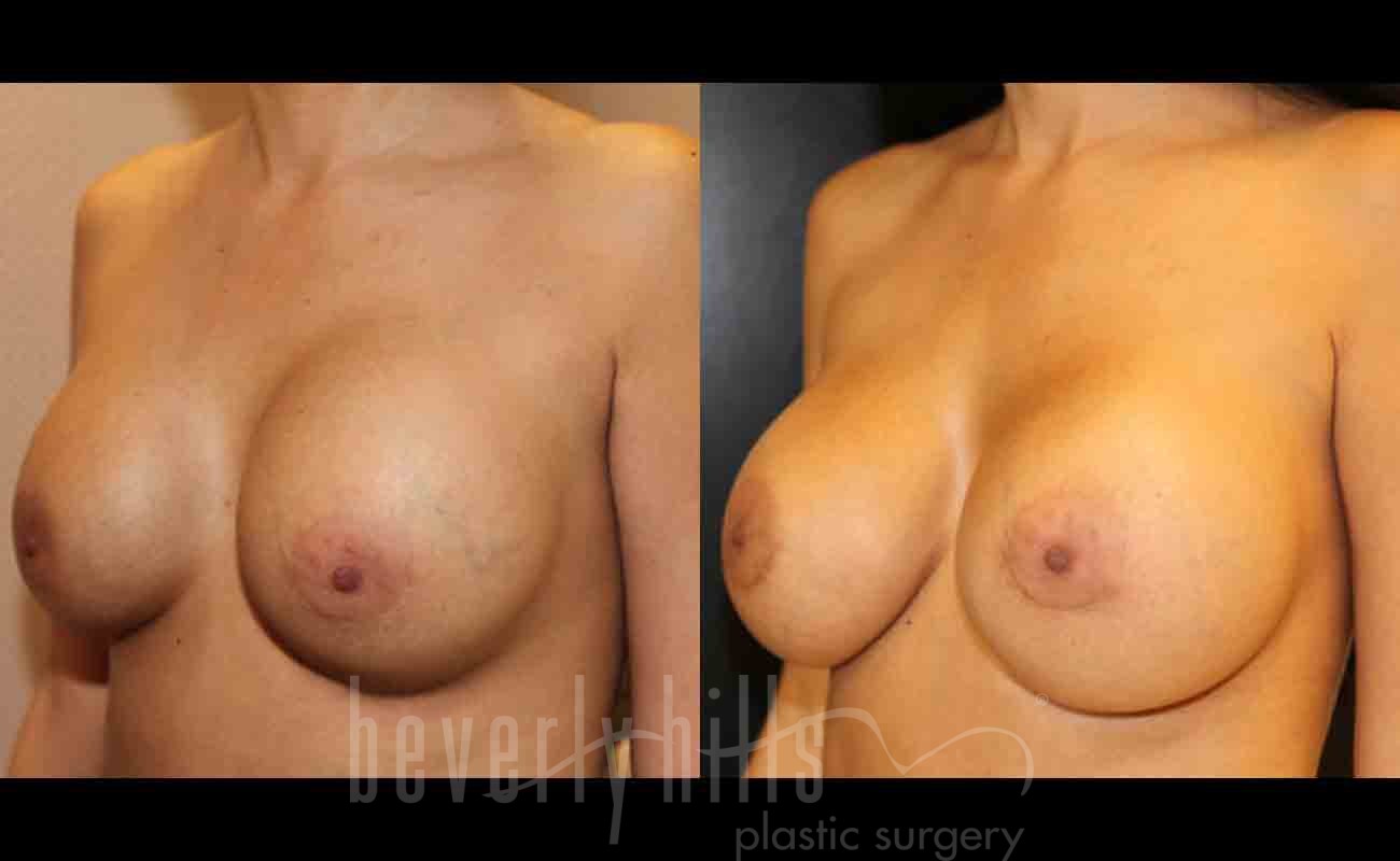 Cosmetic Breast Reconstruction Patient 01 Before & After