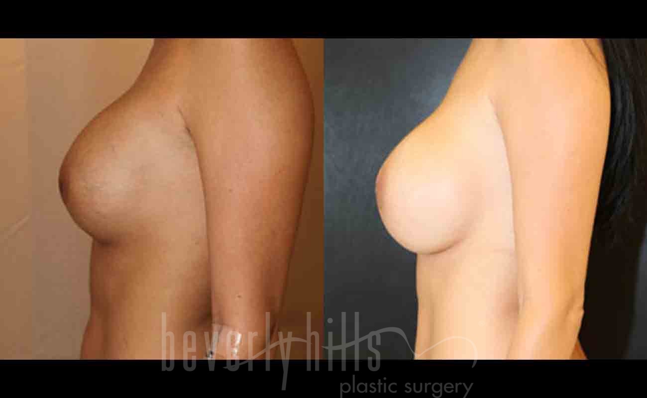 Cosmetic Breast Reconstruction Patient 01 Before & After
