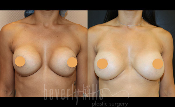 COSMETIC BREAST RECONSTRUCTION PATIENT 02 Before & After