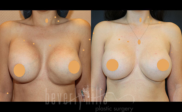 Cosmetic Breast Reconstruction Patient 03 Before & After