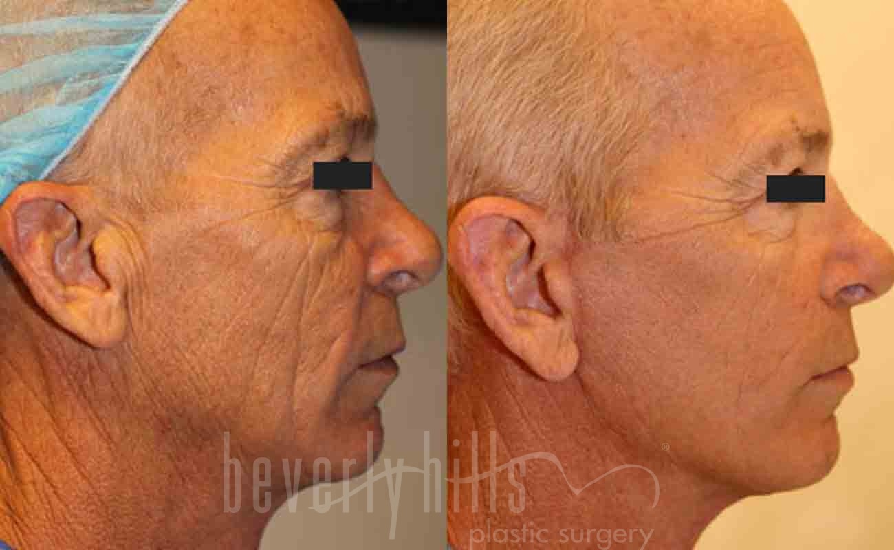 Face Lift Patient 01 Before & After