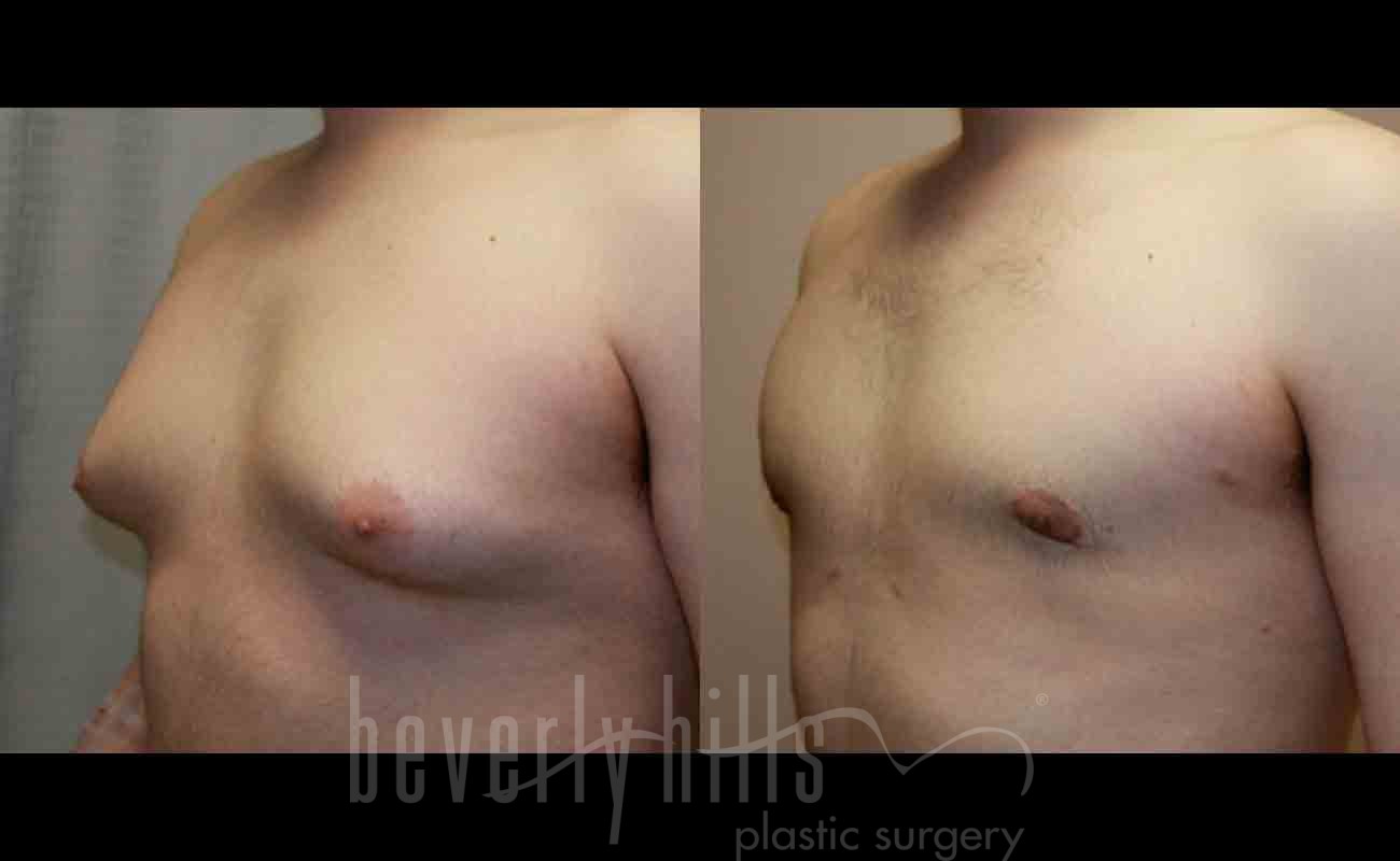 Gynecomastia Patient 04 Before & After