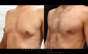 Gynecomastia Patient 18 Before & After - Thumbnail