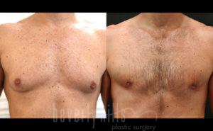 Gynecomastia Patient 18 Before & After - Thumbnail