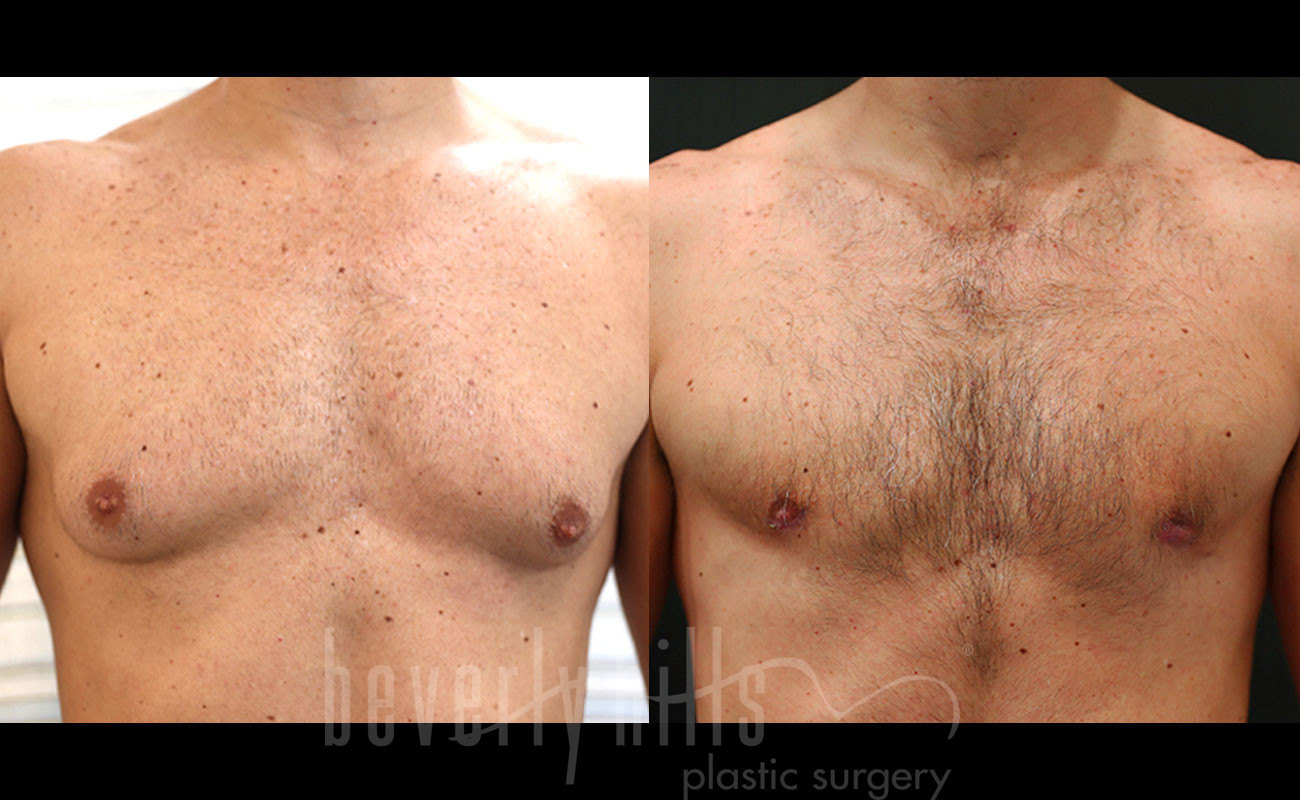 Gynecomastia Patient 18 Before & After