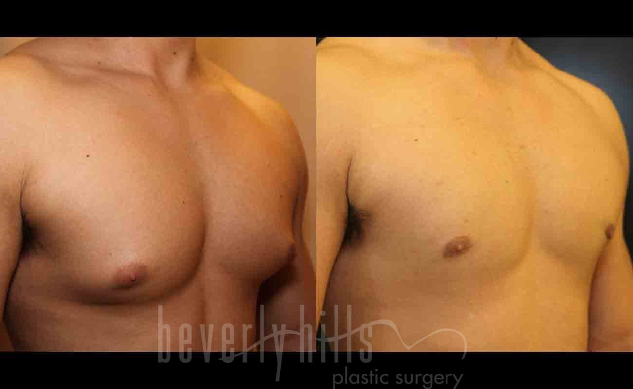 Gynecomastia patient 01 Before & After