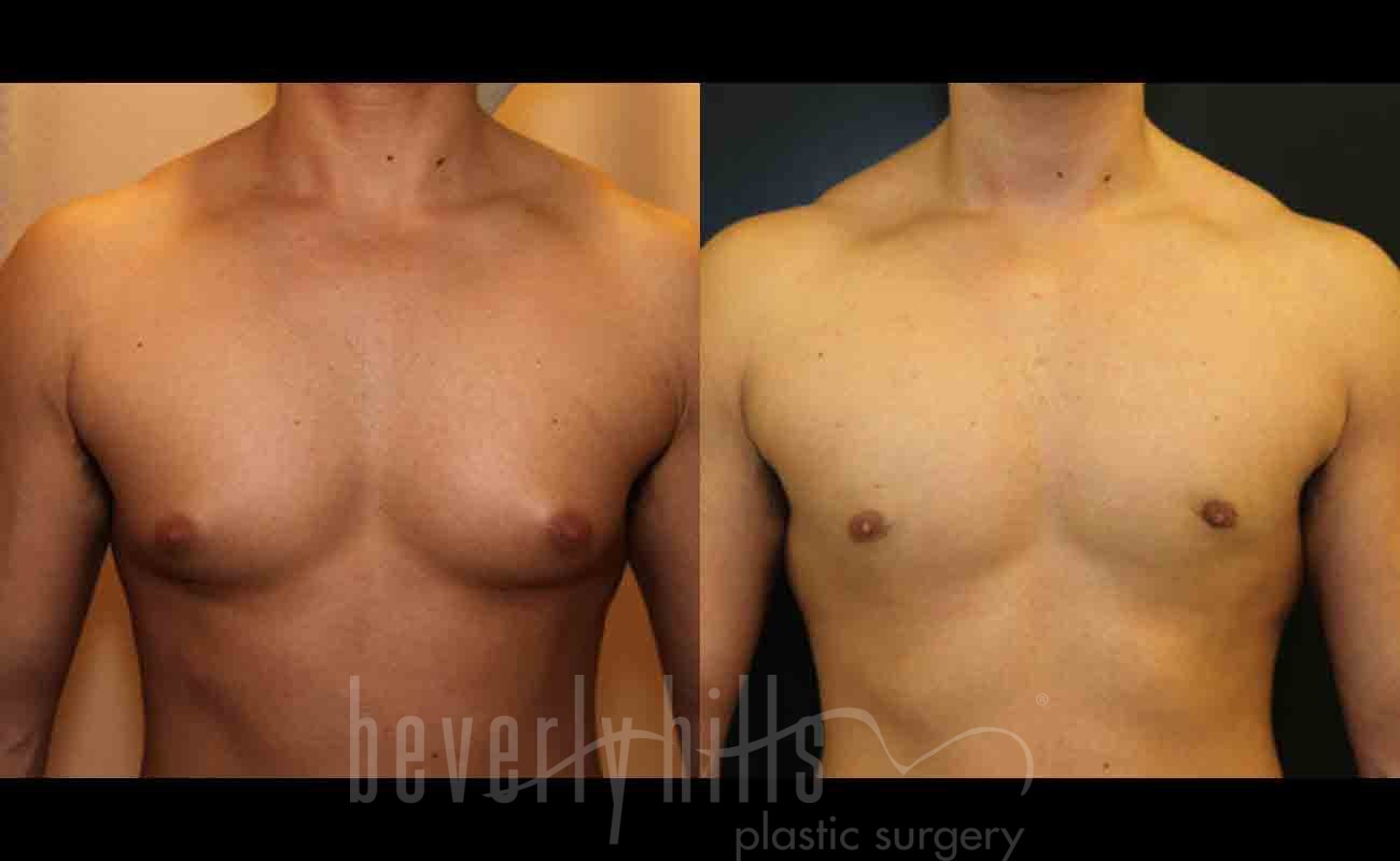 Gynecomastia patient 01 Before & After