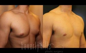 Gynecomastia patient 01 Before & After - Thumbnail