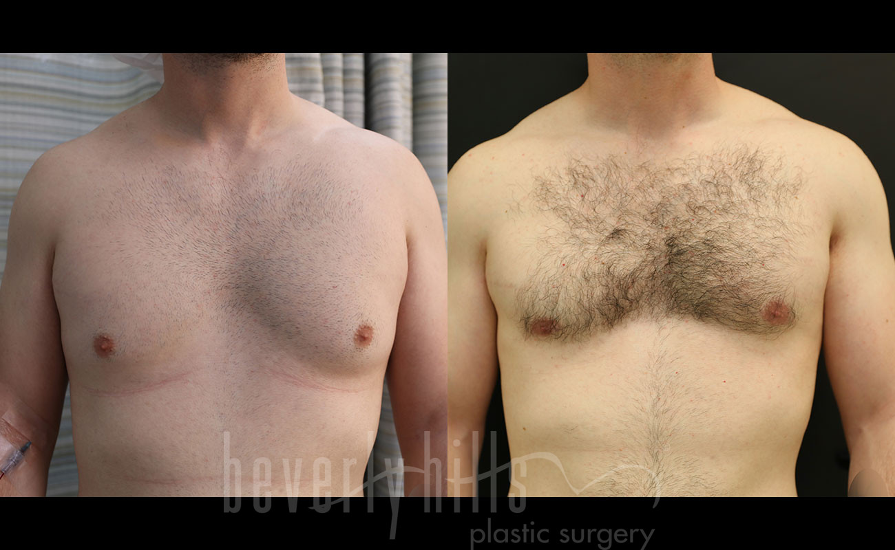 Gynecomastia Patient 12 Before & After