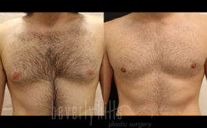 Gynecomastia Patient 11 Before & After - Thumbnail