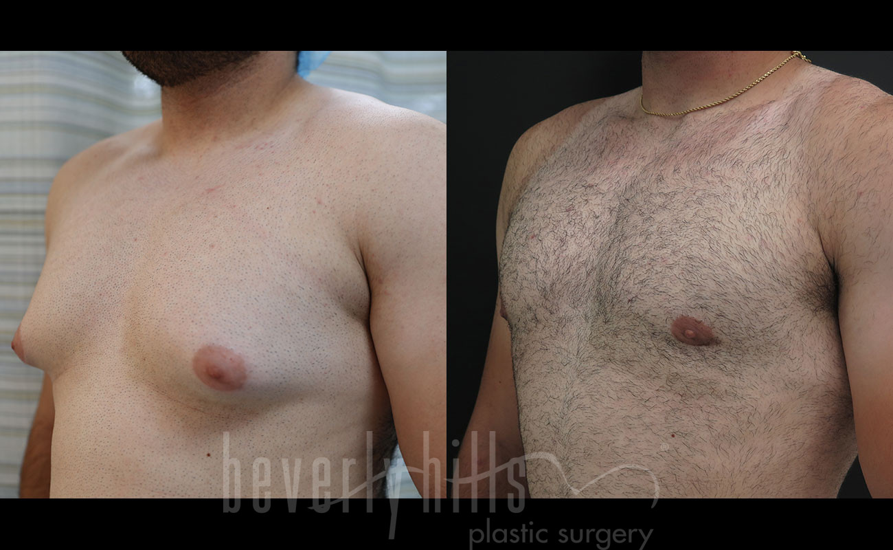 Gynecomastia Patient 13 Before & After