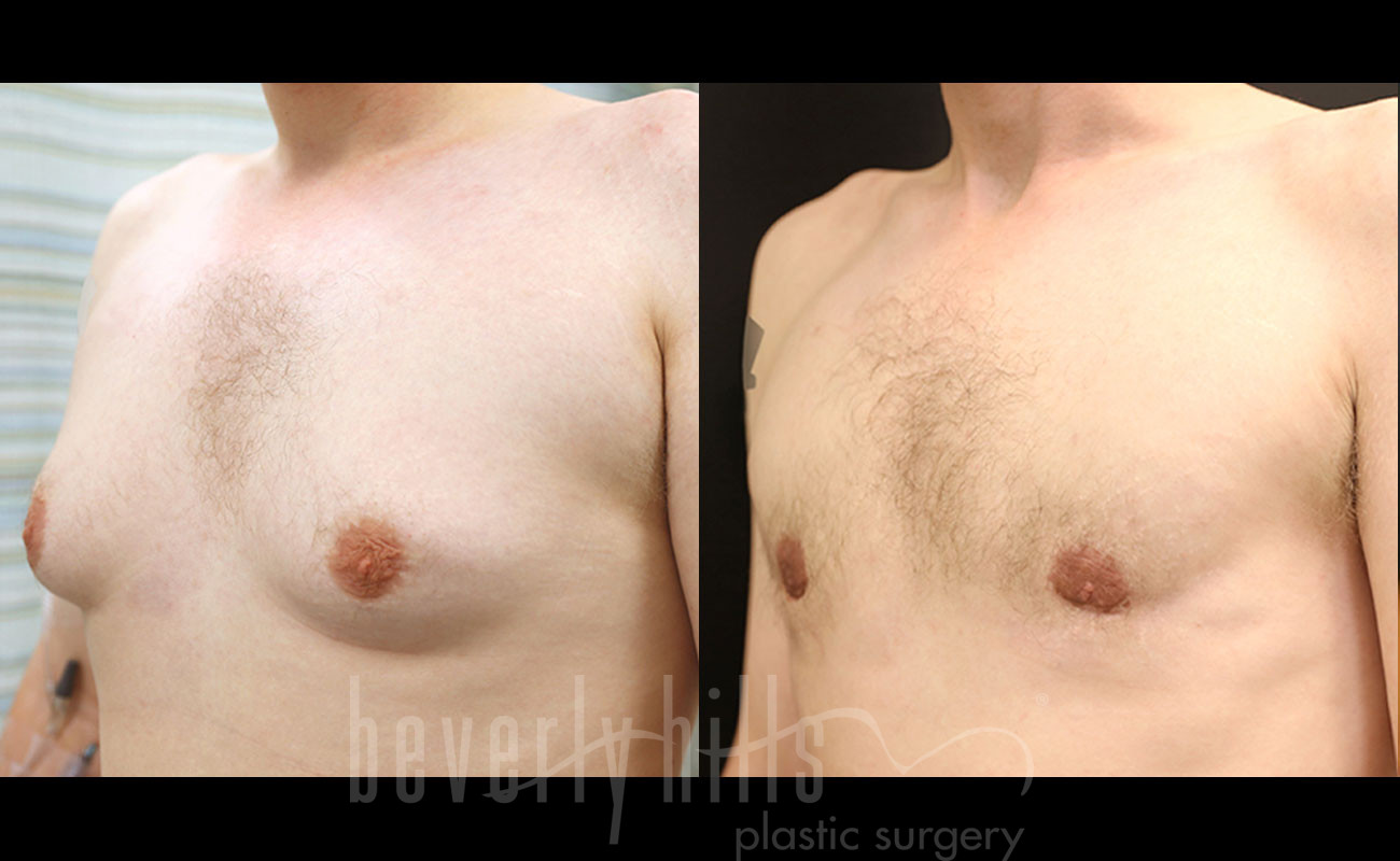Gynecomastia Patient 15 Before & After