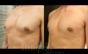 Gynecomastia Patient 16 Before & After - Thumbnail