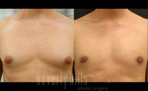 Gynecomastia Patient 16 Before & After - Thumbnail