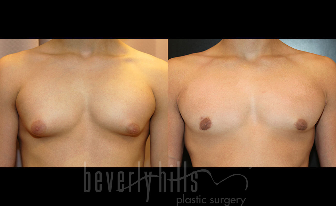 Gynecomastia Patient 17 Before & After