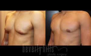 Gynecomastia Patient 17 Before & After - Thumbnail