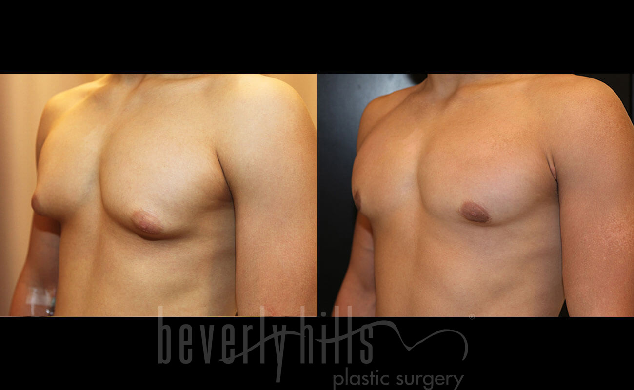 Gynecomastia Patient 17 Before & After