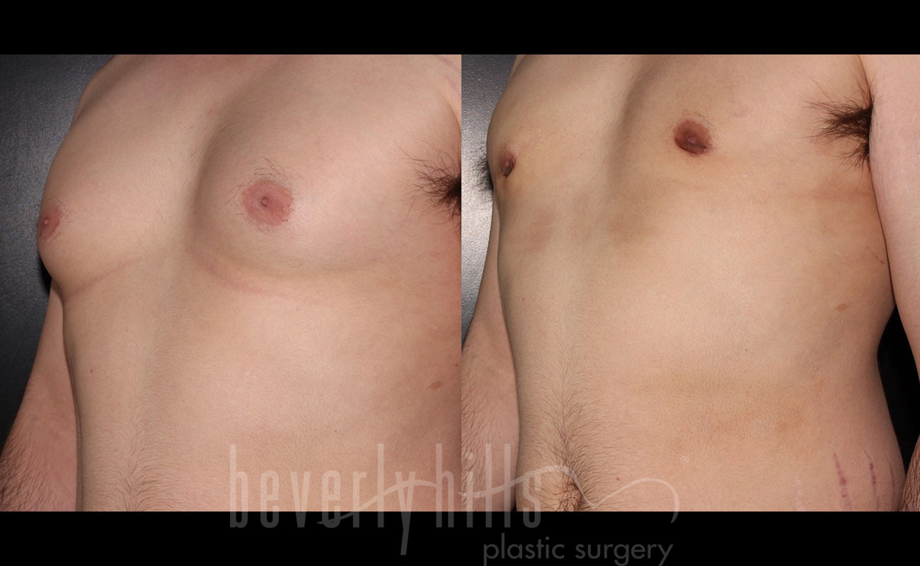 Gynecomastia patient 10 Before & After
