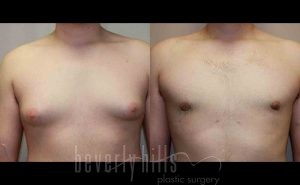 Gynecomastia Patient 04 Before & After - Thumbnail
