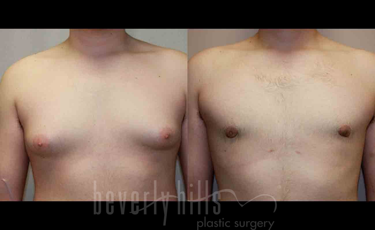 Gynecomastia Patient 04 Before & After