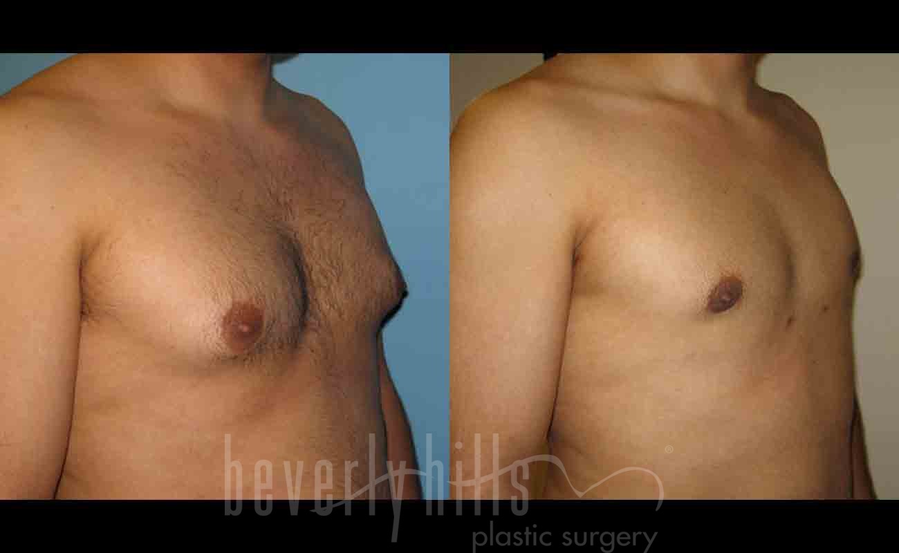 Gynecomastia patient 05 Before & After
