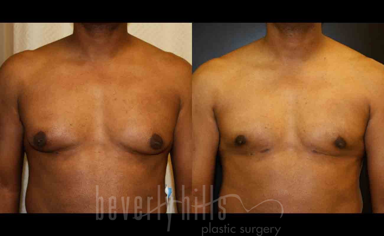Gynecomastia patient 07 Before & After