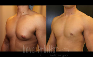 Gynecomastia patient 01 Before & After - Thumbnail