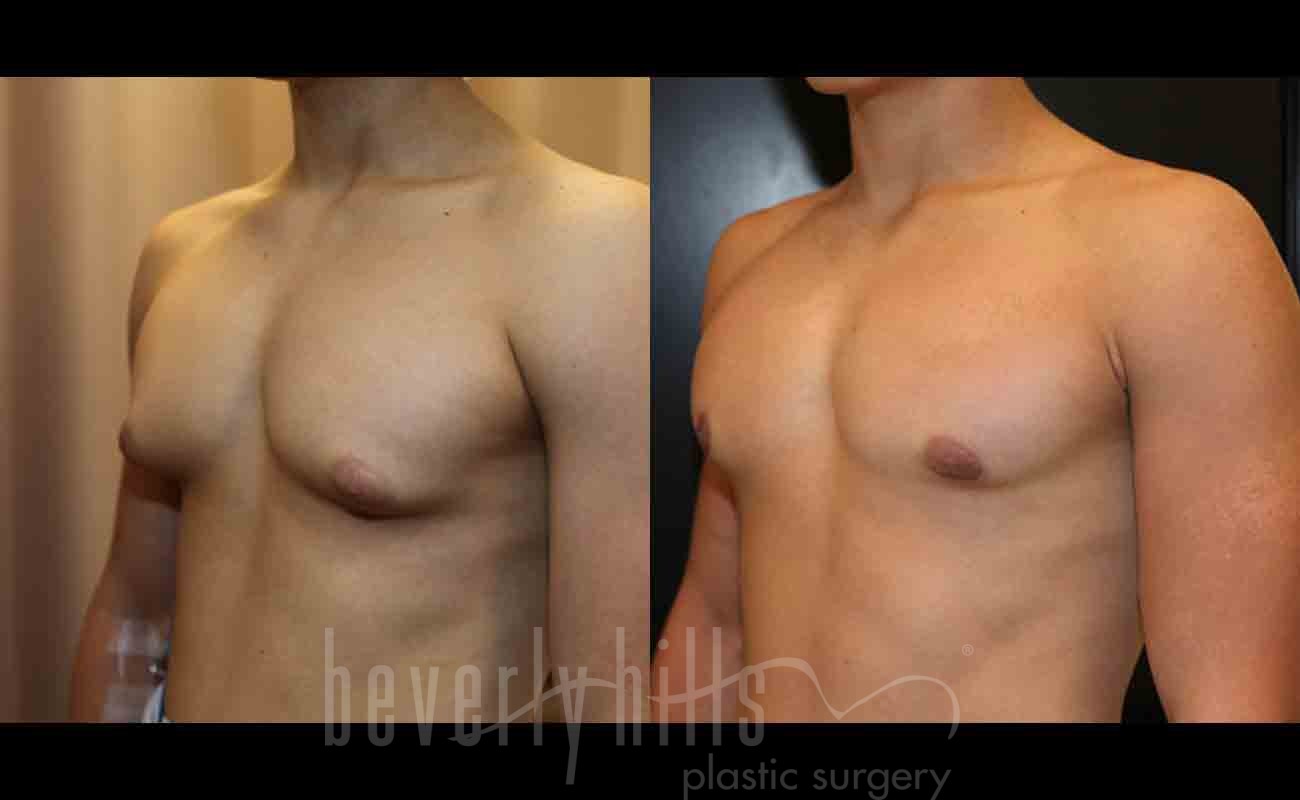 Gynecomastia patient 08 Before & After