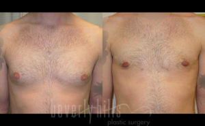 Gynecomastia Patient 14 Before & After - Thumbnail