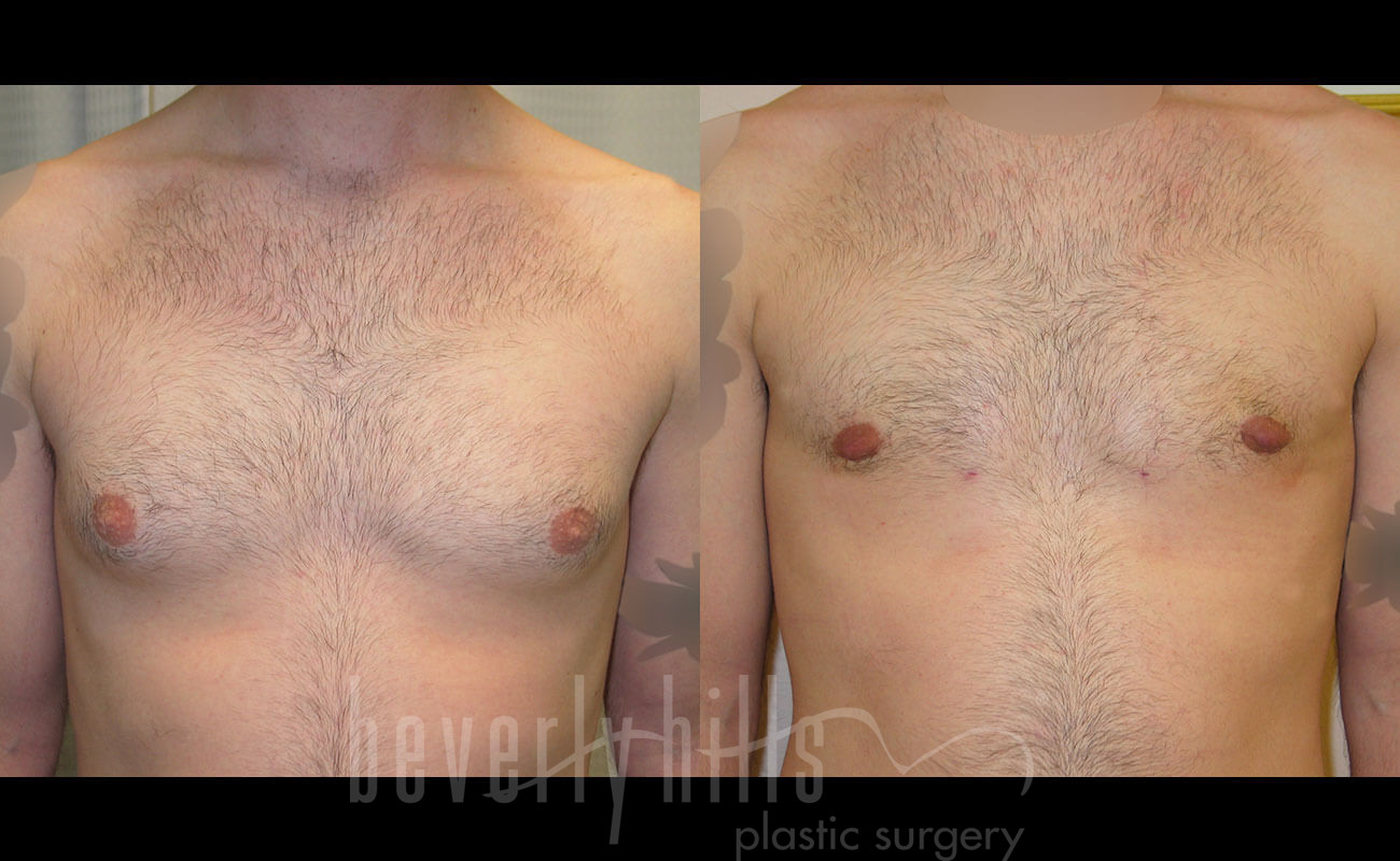 Gynecomastia Patient 14 Before & After